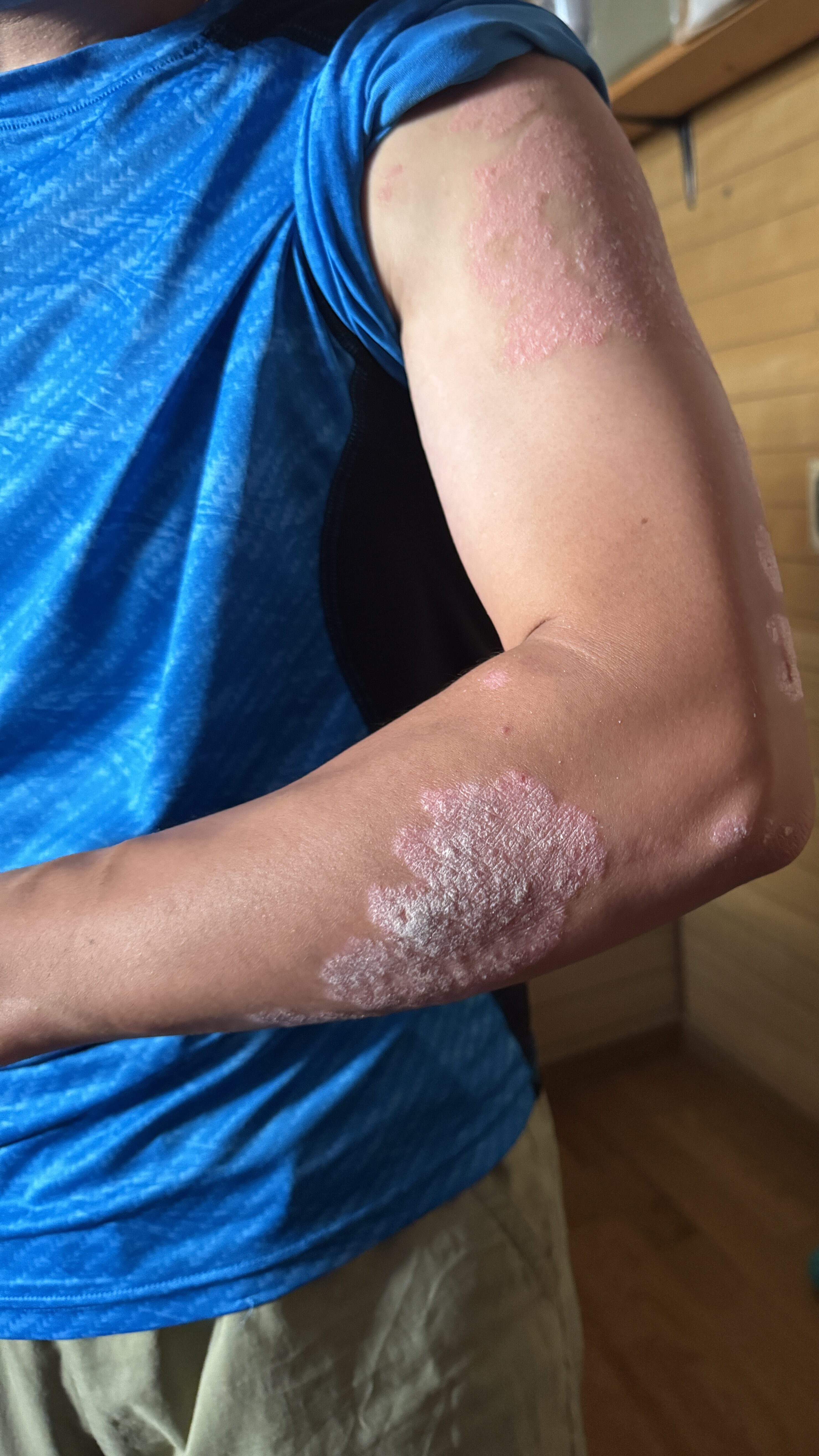 【闘病記】尋常性乾癬と20年以上の付き合い｜皮膚ポロポロ生活のリアルを記録していきます